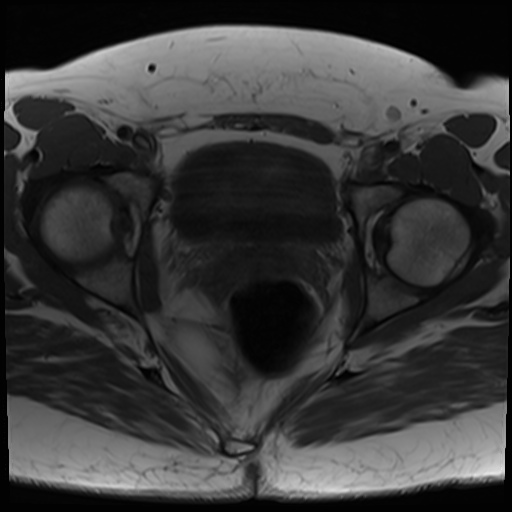 File:Class II Mullerian duct anomaly- unicornuate uterus with rudimentary horn and non-communicating cavity (Radiopaedia 39441-41755 Axial T1 21).jpg