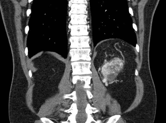 File:Clear cell renal cell carcinoma (Radiopaedia 61449-69393 C 42).jpg