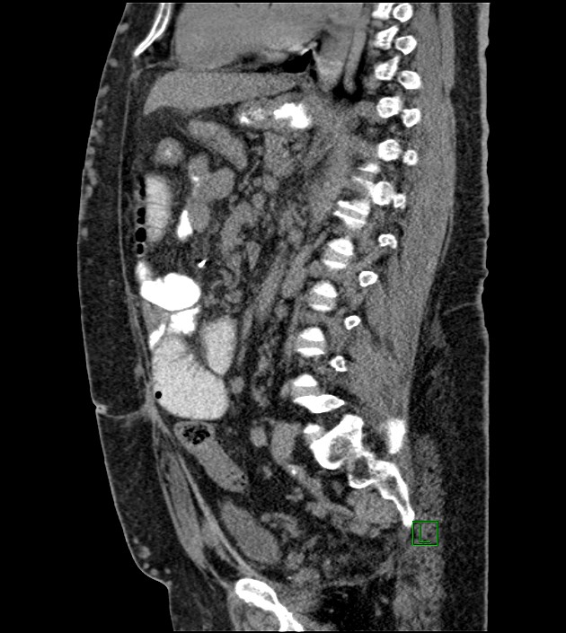Closed-loop small bowel obstruction-internal hernia (Radiopaedia 78439-91096 C 68).jpg