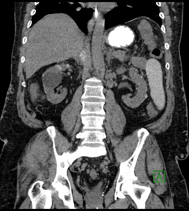 Closed-loop small bowel obstruction-internal hernia (Radiopaedia 78439-91096 Coronal non-contrast 65).jpg