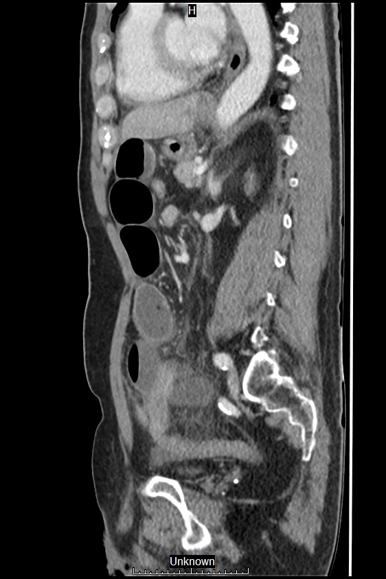 Closed loop bowel obstruction and ischemia (Radiopaedia 86959-103180 C 24).jpg