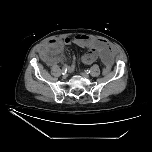 Closed loop obstruction due to adhesive band, resulting in small bowel ischemia and resection (Radiopaedia 83835-99023 Axial non-contrast 110).jpg