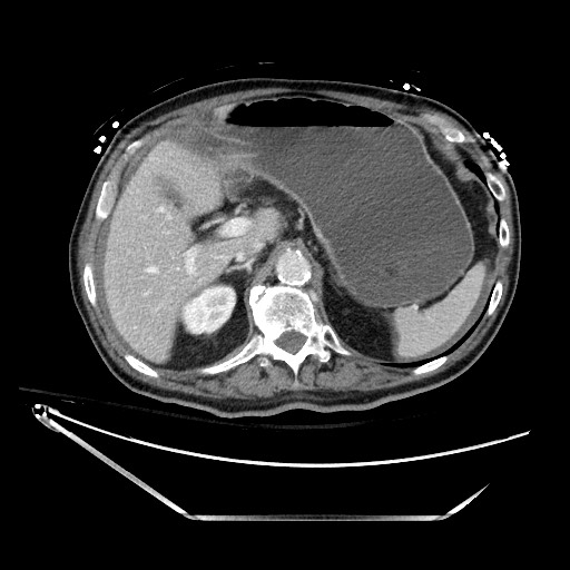 Closed loop obstruction due to adhesive band, resulting in small bowel ischemia and resection (Radiopaedia 83835-99023 D 43).jpg