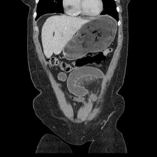 File:Closed loop small bowel obstruction (Radiopaedia 65403-74451 B 34).jpg