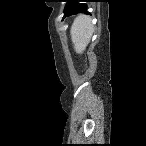 File:Closed loop small bowel obstruction (Radiopaedia 65403-74451 C 2).jpg