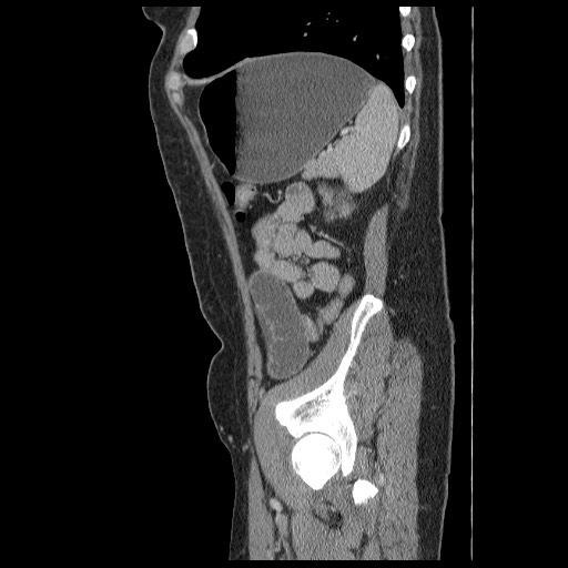 Closed loop small bowel obstruction (Radiopaedia 65403-74451 C 86).jpg