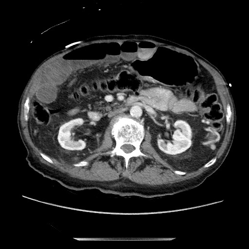 Closed loop small bowel obstruction - adhesive disease and hemorrhagic ischemia (Radiopaedia 86831-102990 A 83).jpg