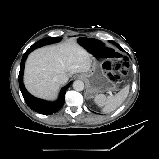 Closed loop small bowel obstruction - omental adhesion causing "internal hernia" (Radiopaedia 85129-100682 A 22).jpg