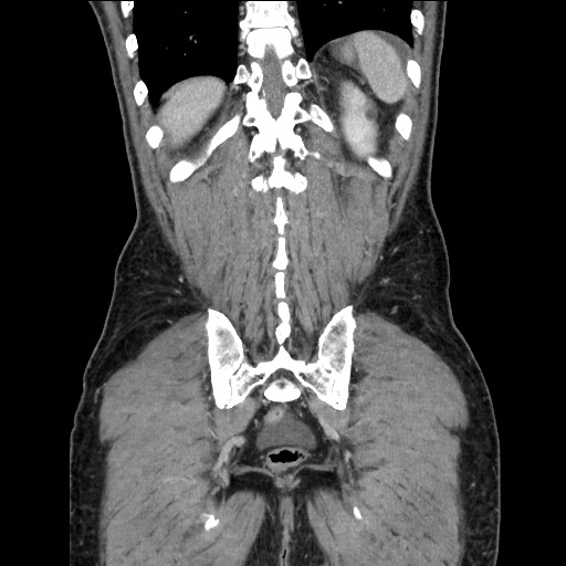 Closed loop small bowel obstruction - omental adhesion causing "internal hernia" (Radiopaedia 85129-100682 B 106).jpg