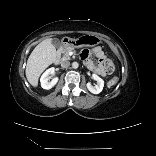 File:Closed loop small bowel obstruction due to adhesive bands - early and late images (Radiopaedia 83830-99014 A 51).jpg