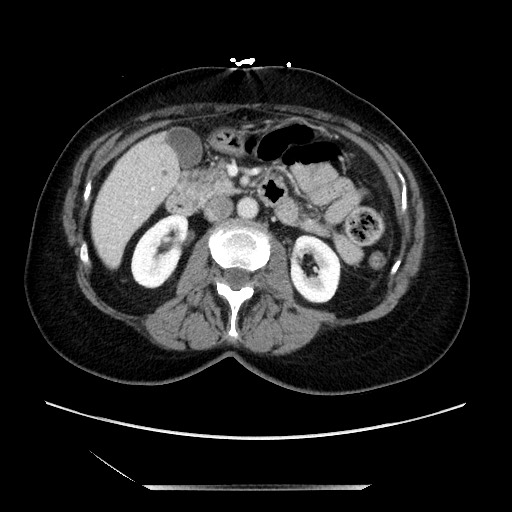 File:Closed loop small bowel obstruction due to adhesive bands - early and late images (Radiopaedia 83830-99014 A 57).jpg