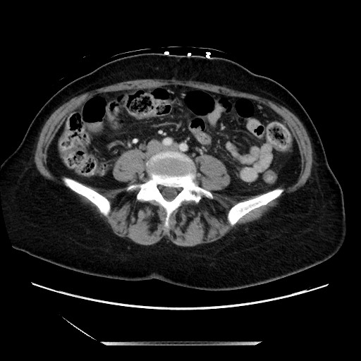 Closed loop small bowel obstruction due to adhesive bands - early and late images (Radiopaedia 83830-99014 A 91).jpg