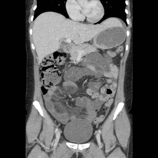 File:Closed loop small bowel obstruction due to trans-omental herniation (Radiopaedia 35593-37109 B 23).jpg