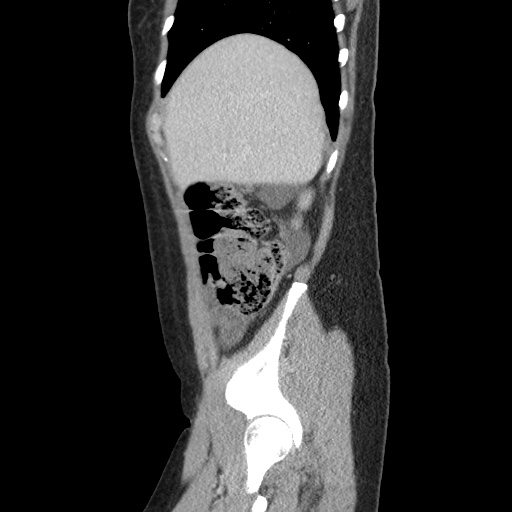 Closed loop small bowel obstruction due to trans-omental herniation (Radiopaedia 35593-37109 C 14).jpg
