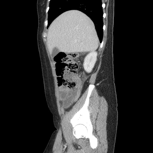 Closed loop small bowel obstruction due to trans-omental herniation (Radiopaedia 35593-37109 C 16).jpg