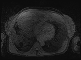 Closed loop small bowel obstruction in pregnancy (MRI) (Radiopaedia 87637-104031 Axial T1 fat sat 1).jpg