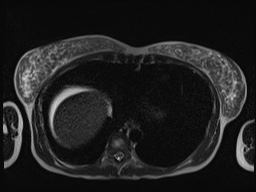 File:Closed loop small bowel obstruction in pregnancy (MRI) (Radiopaedia 87637-104031 Axial T2 5).jpg
