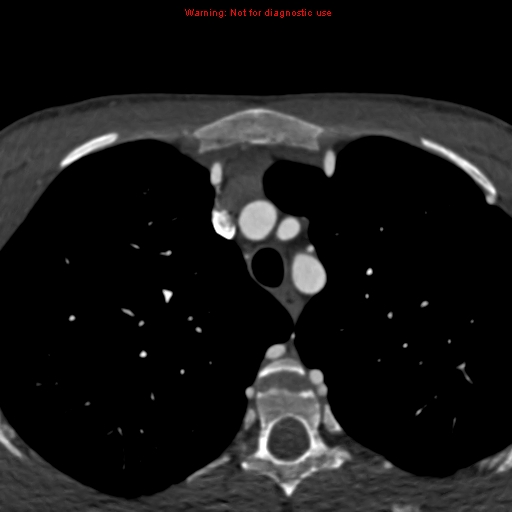 File:Coarctation of the aorta (Radiopaedia 12461-12697 A 21).jpg