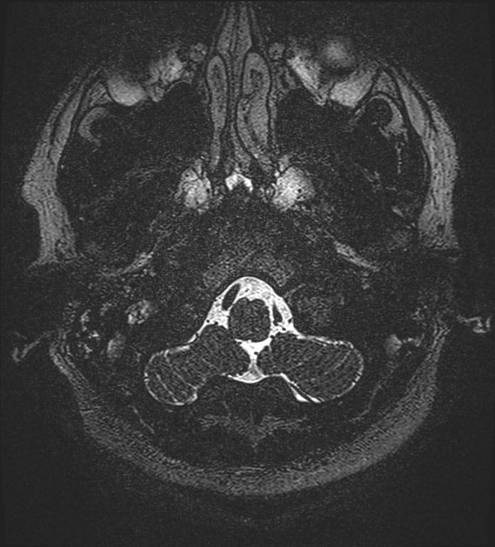 Cochlear incomplete partition type III associated with hypothalamic hamartoma (Radiopaedia 88756-105498 Axial T2 17).jpg