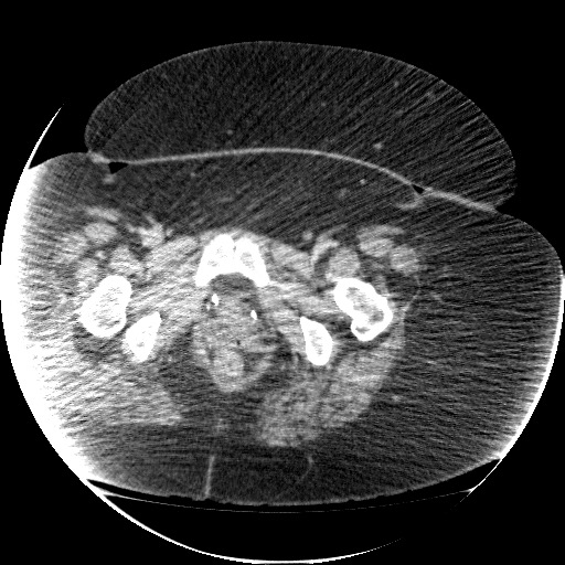 File:Collection due to leak after sleeve gastrectomy (Radiopaedia 55504-61972 A 81).jpg