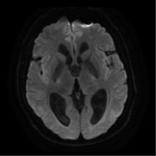 File:Colloid cyst (large) (Radiopaedia 34415-35729 Axial DWI 10).png