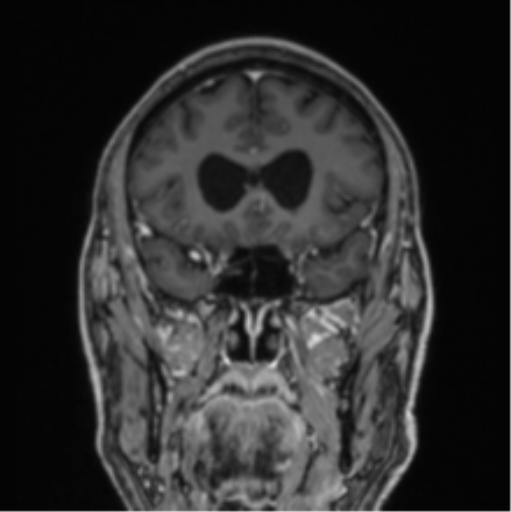 File:Colloid cyst of the third ventricle (Radiopaedia 86571-102662 Coronal T1 C+ 65).png