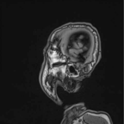 File:Colloid cyst of the third ventricle (Radiopaedia 86571-102662 Sagittal T1 72).png