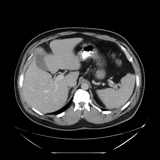 File:Colocolic intussusception due to lipoma (Radiopaedia 73712-84508 Axial 15).jpg