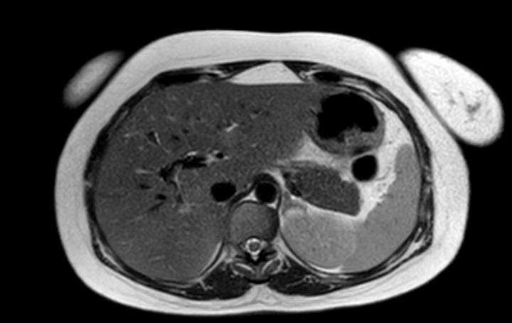 Colon adenocarcinoma with Krukenberg tumors, advanced pregnancy (Radiopaedia 67279-76645 Axial T2 66).jpg