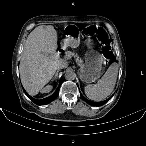 File:Colon cancer (Radiopaedia 90215-107432 Axial non-contrast 24).jpg