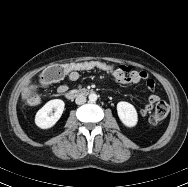 Colon carcinoma with hepatic metastases (Radiopaedia 29477-29961 A 56).jpg