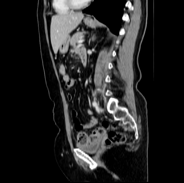 Colon carcinoma with hepatic metastases (Radiopaedia 29477-29961 C 33).jpg