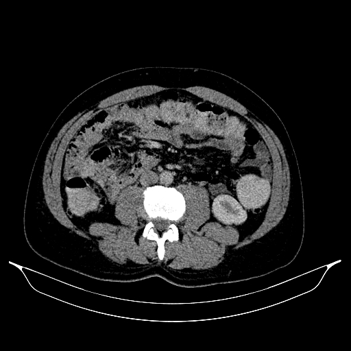 Colonic diverticulosis (Radiopaedia 72222-82744 A 22).jpg