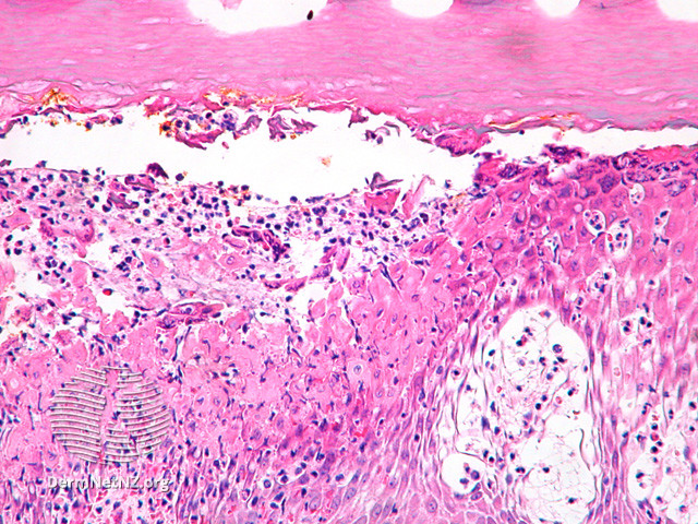 File:Figure 2 (DermNet NZ pathology-e-farmyard-pox-figure-2).jpg