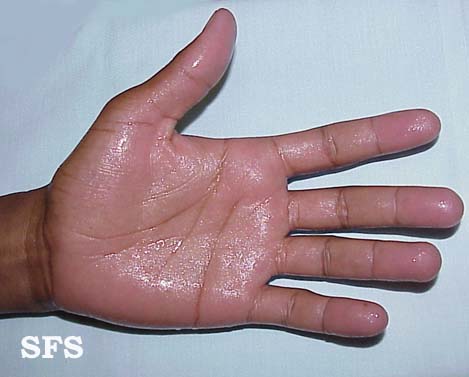 File:Hyperhidrosis (Dermatology Atlas 1).jpg