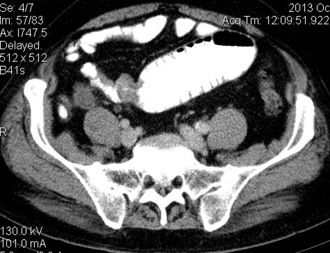 File:Ileal adenocarcinoma causing proximal bowel obstruction (Radiopaedia 25371).jpg