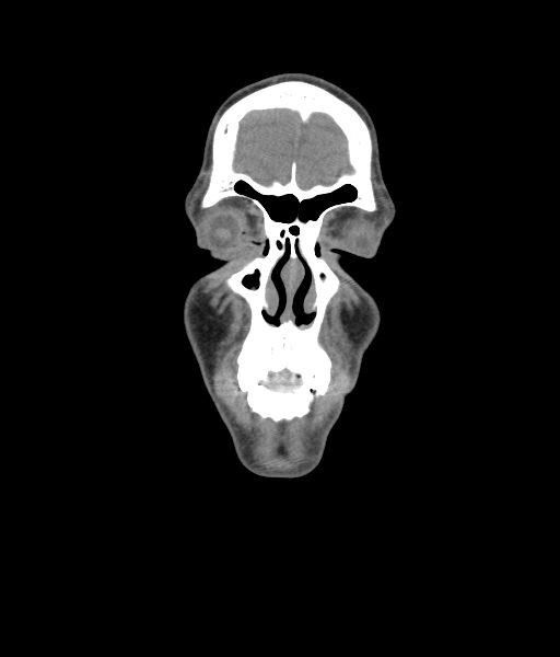 Nasal pyogenic granuloma (lobular capillary hemangioma) (Radiopaedia 85536-101244 Coronal non-contrast 55).jpg