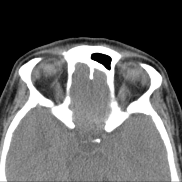Nasolabial cyst (Radiopaedia 33987-35205 Axial non-contrast 41).jpg