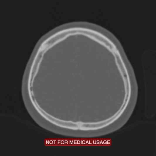 File:Nasopharyngeal carcinoma recurrence - skull base destruction (Radiopaedia 29107-29490 Axial bone window 24).jpg