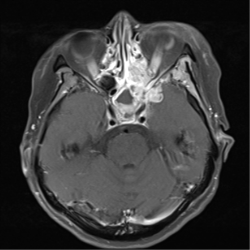 File:Nasopharyngeal carcinoma with cerebral abscess (Radiopaedia 43018-46273 Axial T1 C+ fat sat 12).png