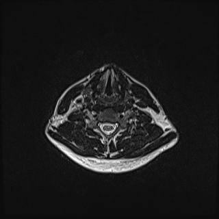 Nasopharyngeal carcinoma with perineural spread (Radiopaedia 55030-61380 Axial T2 64).jpg