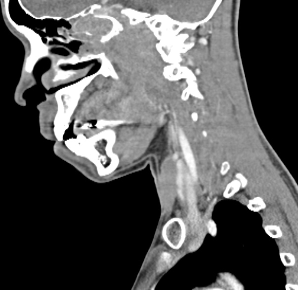Nasopharyngeal carcinoma with skull base invasion (Radiopaedia 53415-59705 C 45).jpg