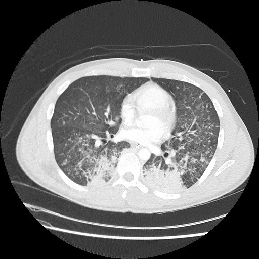 Near-drowning pulmonary edema (Radiopaedia 59457-66814 Axial lung window 33).jpg