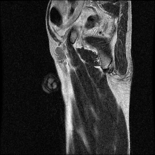 File:Necrotizing epididymo-orchitis with intra-testicular abscess (Radiopaedia 29397-29860 Sagittal T2 3).jpg