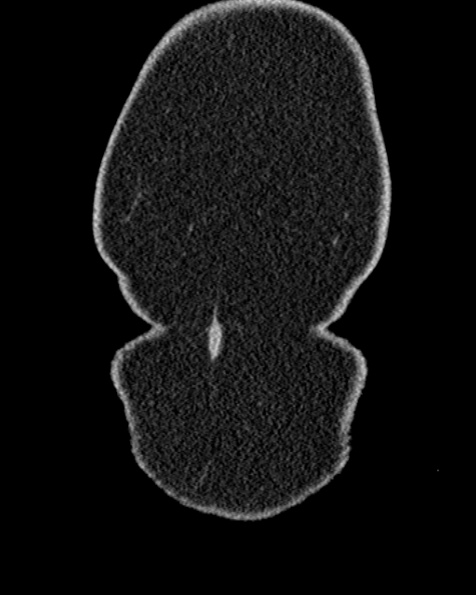 File:Nephrostomy for urosepsis (Radiopaedia 26180-26330 non-contrast 3).jpg