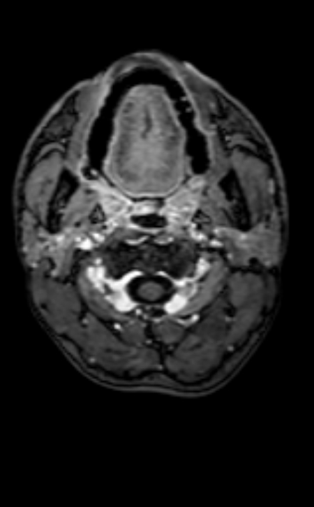 Neuro-Behçet disease (Radiopaedia 90112-107294 Axial T1 C+ 220).jpg