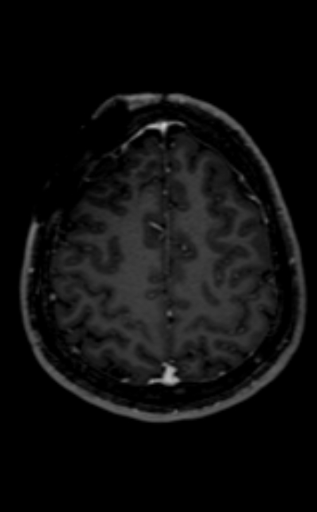Neuro-Behçet disease (Radiopaedia 90112-107294 Axial T1 C+ 80).jpg