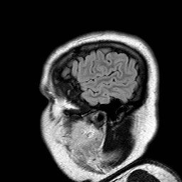 File:Neuro-Behcet's disease (Radiopaedia 21557-21506 Sagittal FLAIR 1).jpg