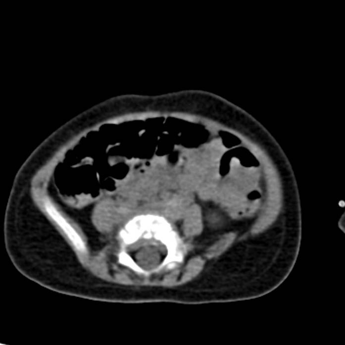Neuroblastoma with skull metastases (Radiopaedia 30326-30960 Axial non-contrast 41).jpg