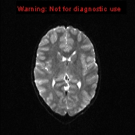 File:Neurofibromatosis type 1 with optic nerve glioma (Radiopaedia 16288-15965 Axial DWI 11).jpg
